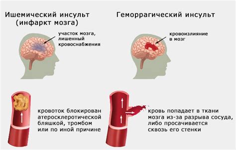 Какие последствия остаются после инсульта?