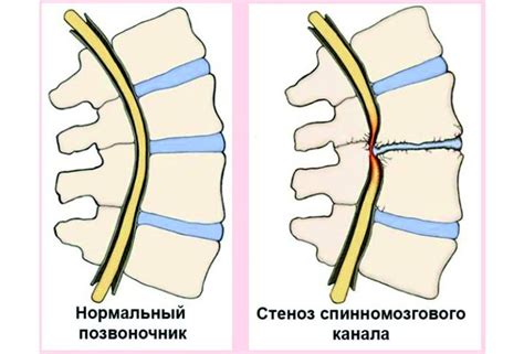 Какие предусмотрены методы лечения сужения костного позвоночного канала?