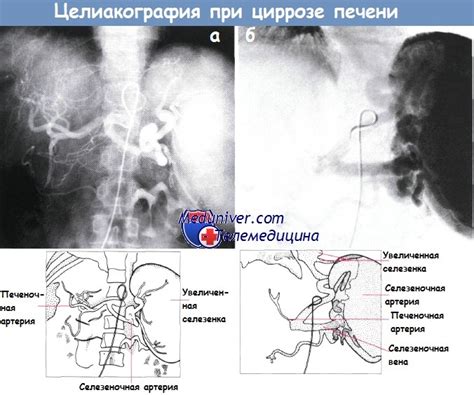 Какие причины возникновения гепаторенального синдрома при циррозе?