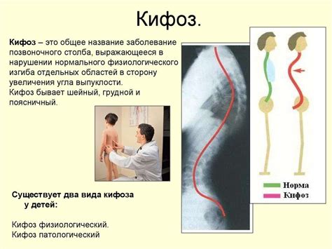 Какие причины лежат в основе развития физиологического грудного кифоза?