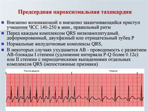 Какие причины могут вызвать приступ тахикардии?