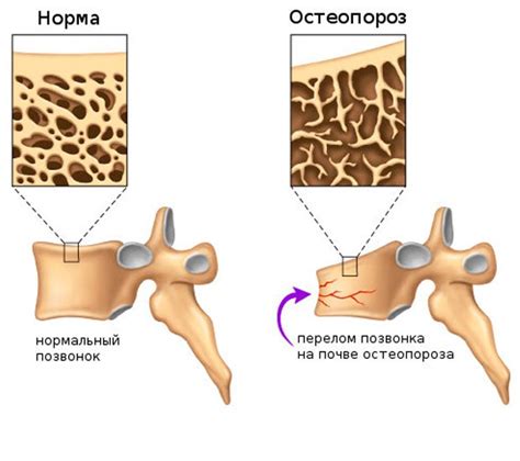 Какие причины могут вызывать патологический перелом позвонка?