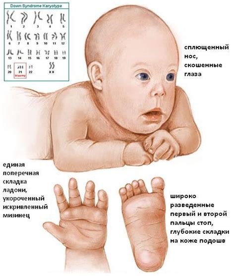 Какие проблемы могут возникнуть у ребенка с синдромом Дауна?