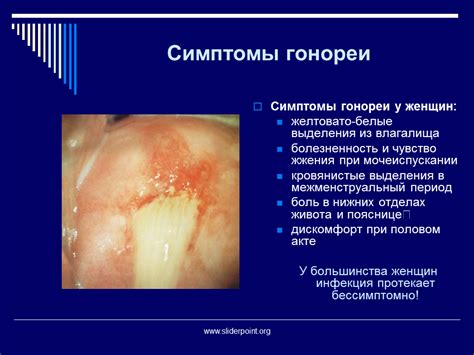 Какие симптомы возникают при гонорее?