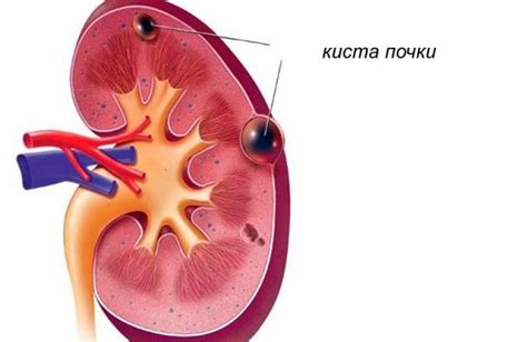 Какие симптомы свидетельствуют о наличии осложненной кисты почки?