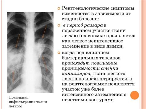 Какие симптомы сопровождают инфильтративные изменения правого легкого?