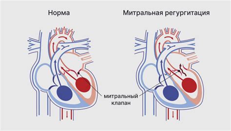 Какие симптомы сопровождают недостаточность митрального клапана?