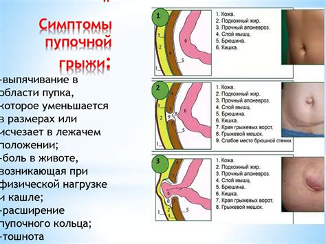 Какие симптомы сопровождают пупочную грыжу?