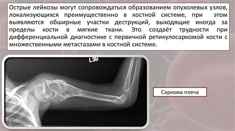 Какие симптомы сопровождают субтотальное поражение костей?