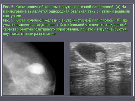 Какие симптомы указывают на наличие сложной кисты молочной железы?