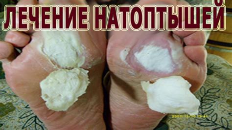 Какие существуют методы лечения натоптышей