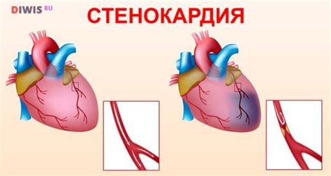 Каковы основные симптомы систула сердца?