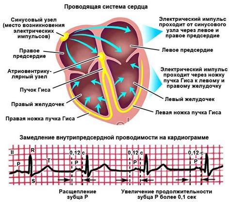 Каковы причины возникновения нарушений желудочковой проводимости?