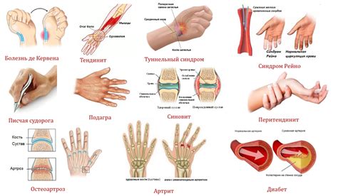 Каковы симптомы свелой кисти руки?