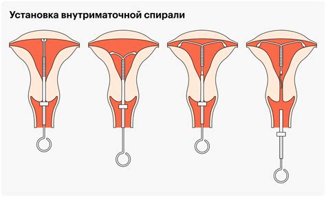 Как внутриматочная спираль помогает предотвратить беременность