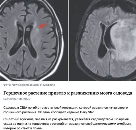 Как возникает разжижение мозгов?