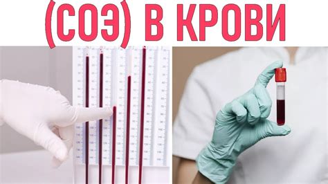 Как диагностировать Соэ 30 у подростка?