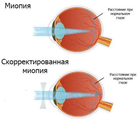 Как диагностировать миопию 1 степени глаза?