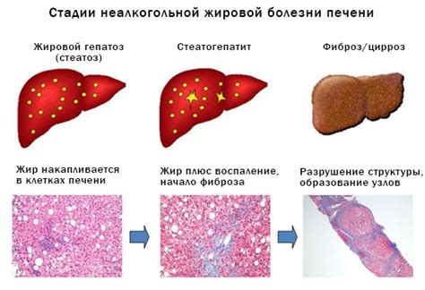 Как диагностировать нажбп стеатогепатит?