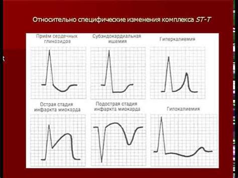 Как диагностировать нарушение реполяризации передней стенки левого желудочка