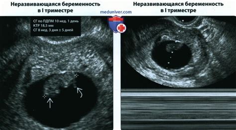 Как диагностировать опущенное плодное яйцо