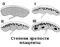 Как диагностировать ранее созревание плаценты?