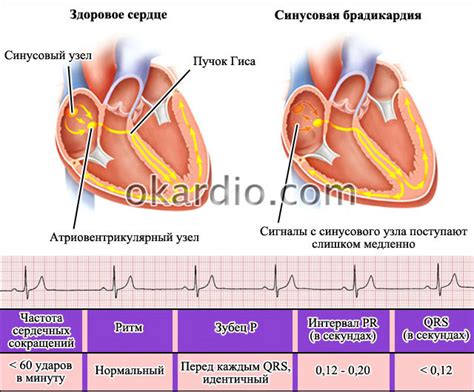 Как диагностировать синусовую брадикардию при ЭКГ?