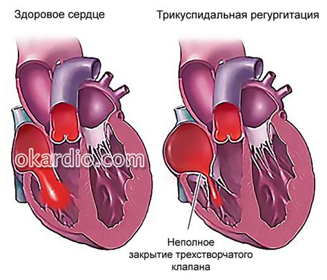 Как диагностировать трикуспидальную регургитацию?