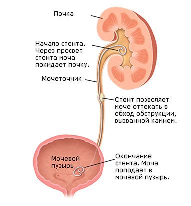 Как диагностировать цистоидный мочеточник?