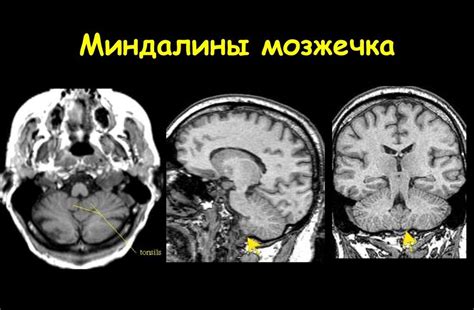 Как дистопия миндалин мозжечка влияет на организм?