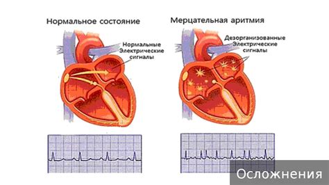 Как контролировать мерцательную аритмию?