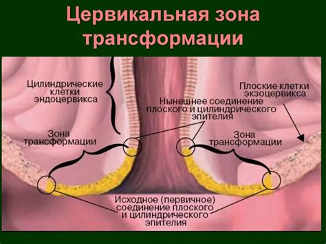 Как лечить расширенный цервикальный канал