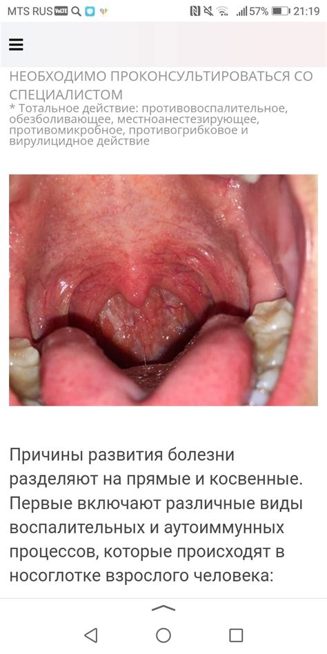 Как лечить рыхлое горло и чему следует избегать