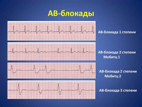 Как лечить транзиторную ав блокаду 1 степени?