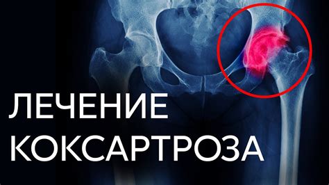 Как лечить 1 стадию коксартроза