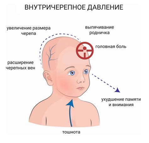 Как определить внутричерепное давление у ребенка самостоятельно