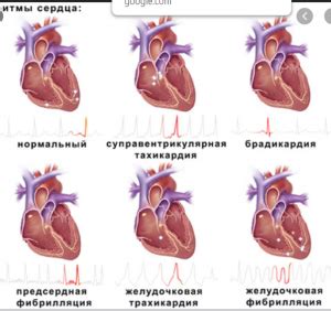 Как определить наличие правопредсердного ритма у ребенка?