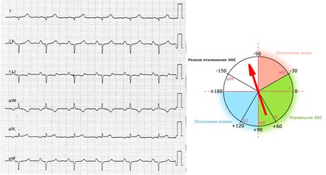 Как определить нормальное положение электрической оси сердца?