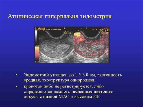 Как определить отражение от эндометрия среднее?