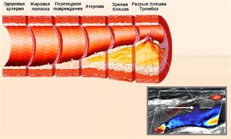 Как определить перевязку кровеносных трубок с помощью УЗИ?