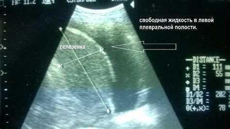 Как определить степень затемнения плевральных синусов?