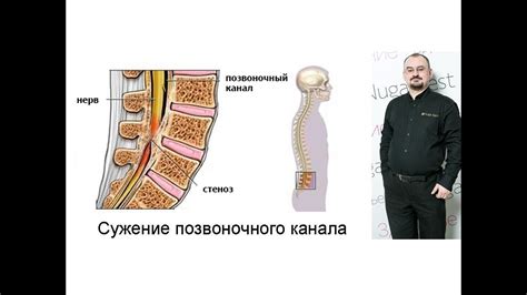 Как определить сужение костного позвоночного канала?