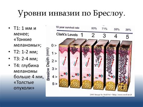 Как определить уровень инвазии по Кларку?