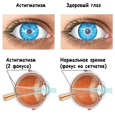 Как отличить нормальное бегание глаз от патологического?