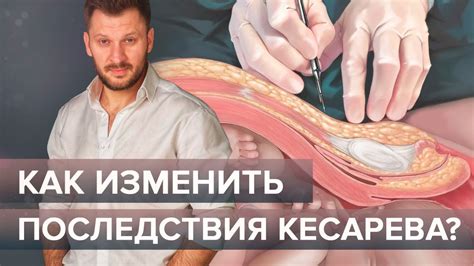 Как повышается уровень лейкоцитов после кесарева сечения?