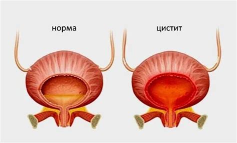 Как предотвратить неспецифическое воспаление женских органов?