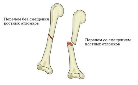 Как предотвратить переломы без смещения?