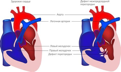 Как предотвратить расширение сердца