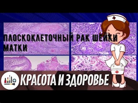 Как проводится исследование цитограммы для выявления цервицита