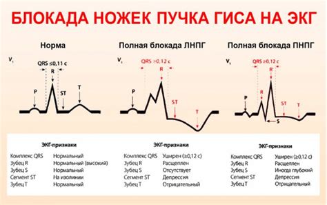 Как проводится лечение блокады пучка Гиса?